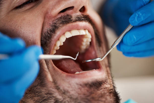 Best Knocked-Out Tooth (Avulsed Tooth) Treatment in St Marys, WV